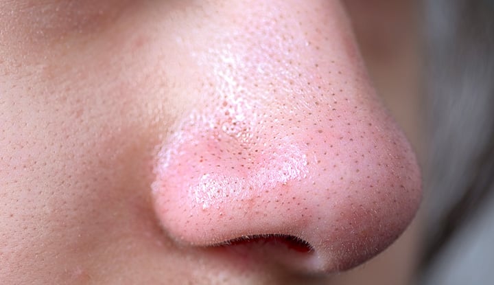 blackheads on nose