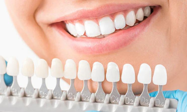 Everything About Dental Veneers & Their Cost