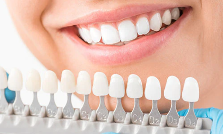 veneers cost