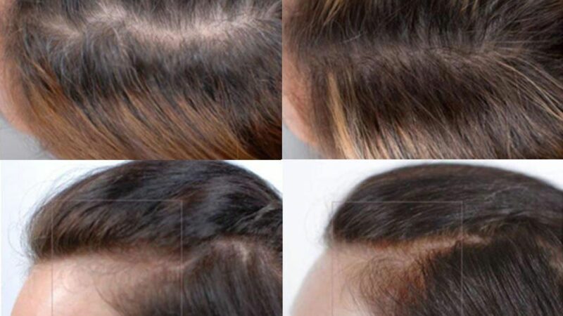 Nutrafol: Hair Loss Review