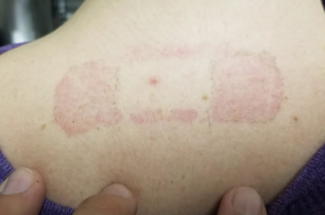 bandaids - News Home allergic to bandaids