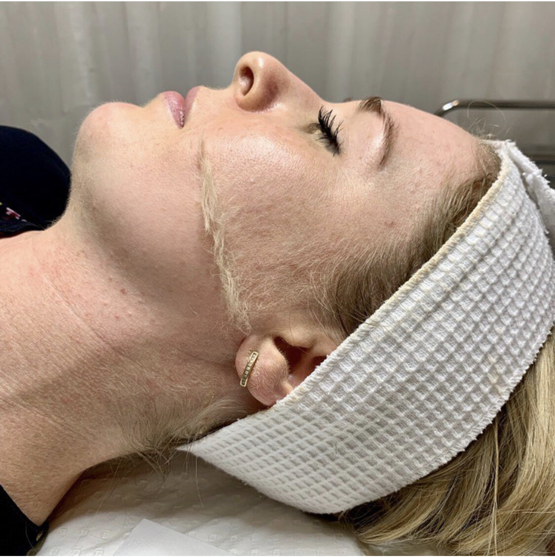 dermaplane - News Home dermaplane